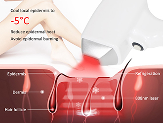 Fast hair removal; Non-invasiveand painless; Silent System; Intelligent constanttemperature4°C
